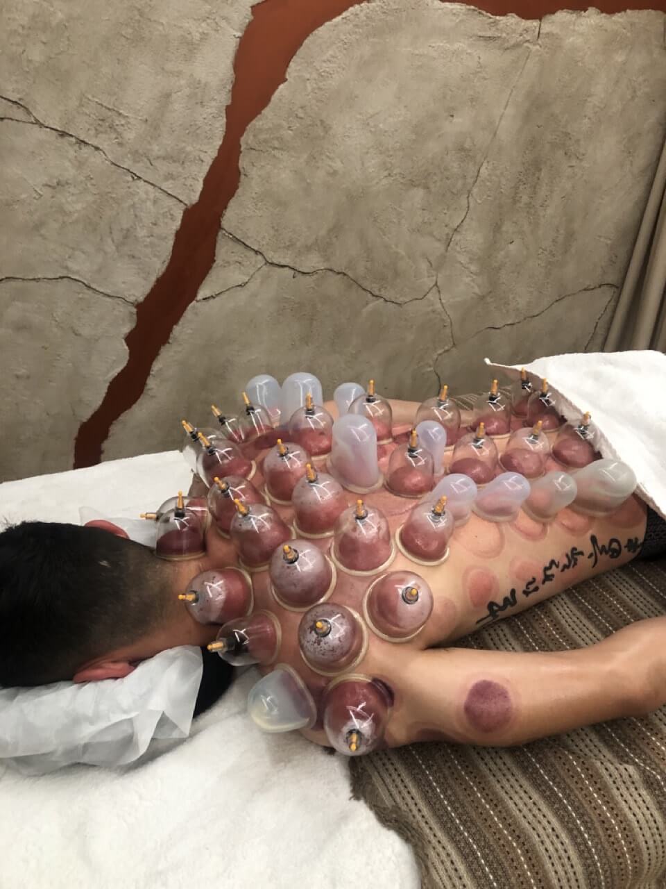 the-healing-touch-ventouzotherapeia-acharnes-sportshunter-16