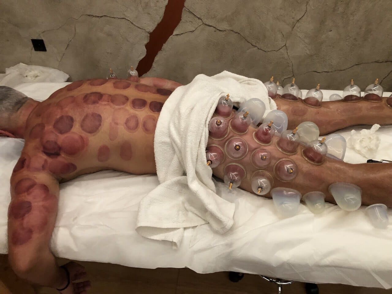 the-healing-touch-ventouzotherapeia-acharnes-sportshunter-17