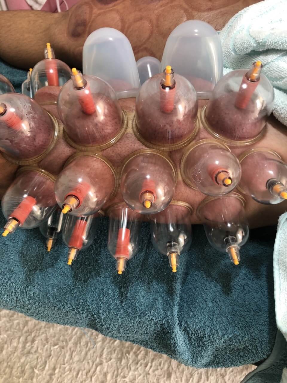 the-healing-touch-ventouzotherapeia-acharnes-sportshunter-18