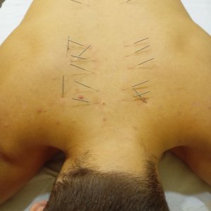 Βελονισμός